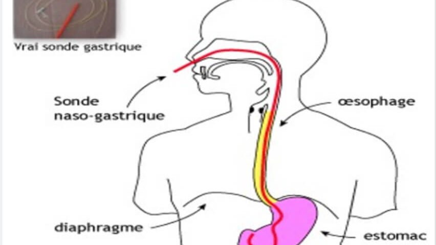 entretien d'une sonde gastrique
